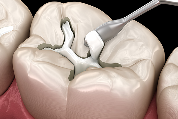 Composite material used in dentistry include fillings