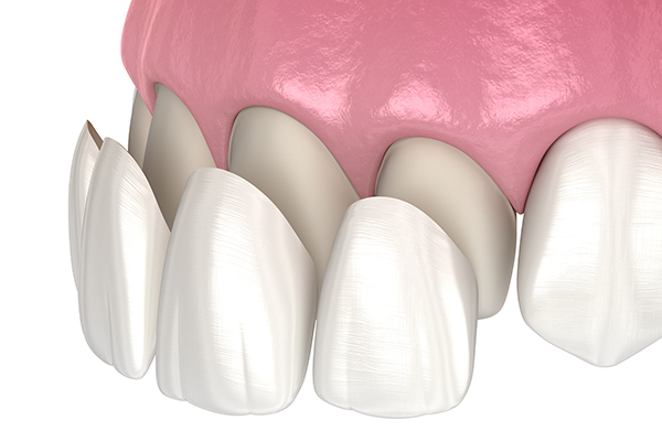 Composite material used in dentistry include veneers
